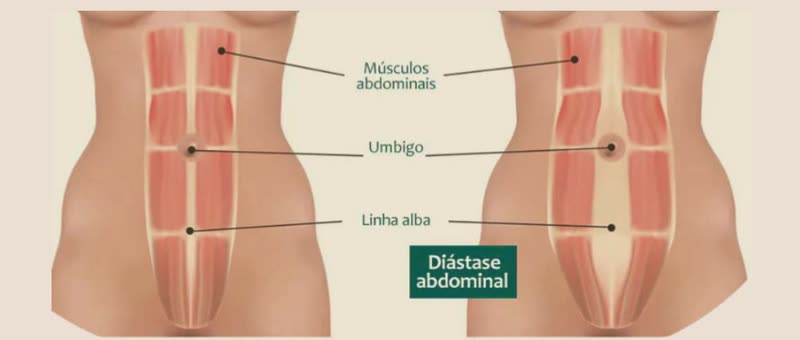 Ilustração comparando um abdômen com os músculos retos abdominais juntos e outro com diástase abdominal, mostrando o afastamento na linha alba ao redor do umbigo